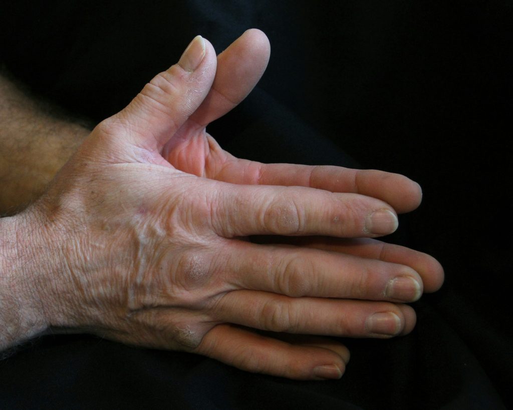 Symptômes arthrose main chez senior